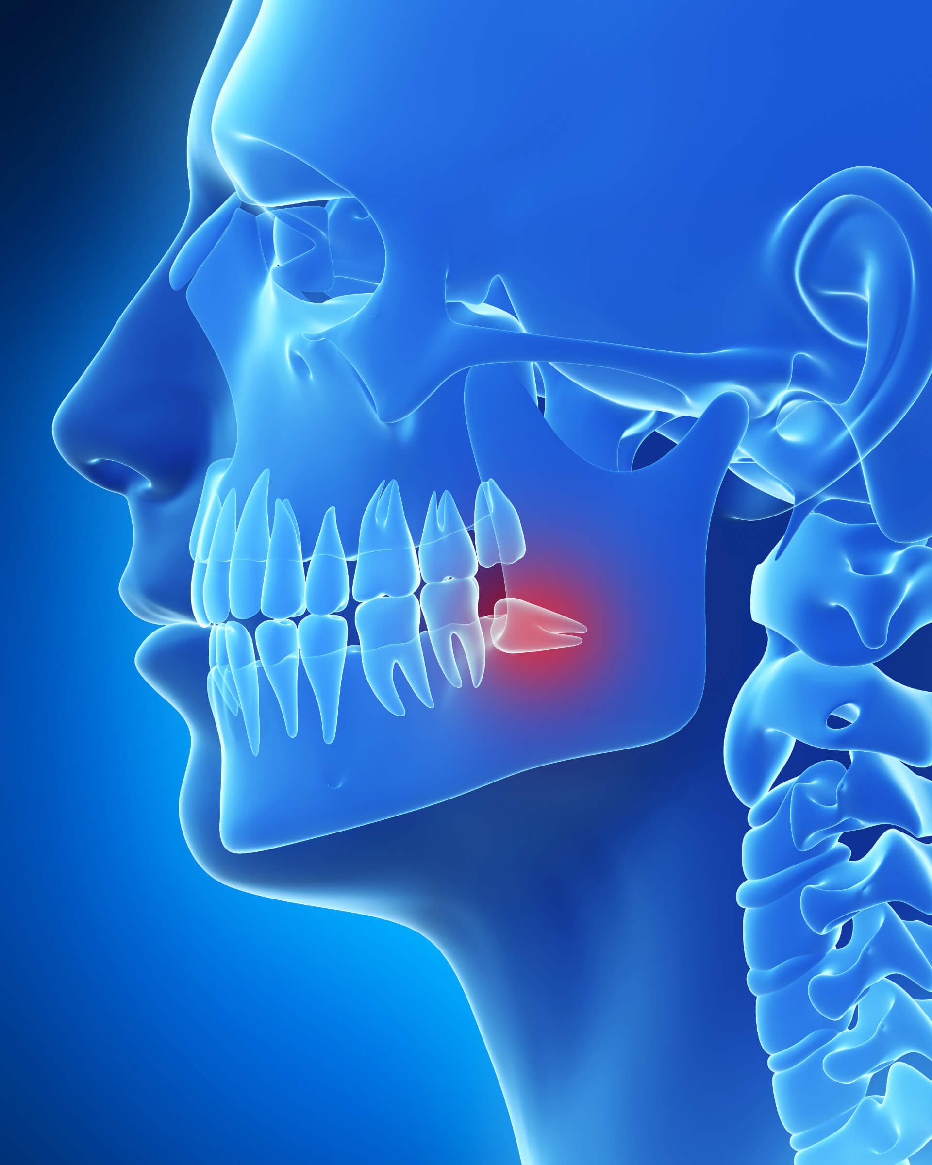 Impacted Wisdom Teeth Impacted Wisdom Teeth